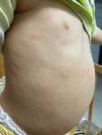 Сыпь на теле у ребёнка в возрасте 1.4 фото 1