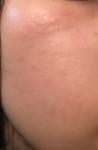 Раздражение или аллергия кожи лица фото 2