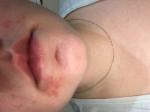 Покраснения и шелушения на лице после родов фото 2