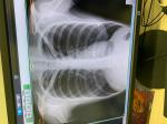 Расшифровка рентгена легких. Плевродиафрагмальные спайки фото 1