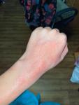 Сыпь на руках, аллергия, краснеет и печёт вечером фото 5