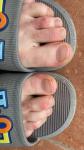 Сыпь на пальцах ног ночной зуд фото 2