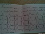 Помогите, пожалуйста, расшифровать кардиограмму и подтвердить диагноз фото 2