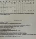 Синдром ранней реполяризации желудочков, желудочковые экстраситолы, головокружение, фото 3