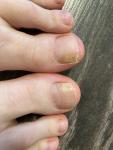 Проблема с ногтями и пятнами на ногах фото 1