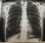 Рентген лёгких, чувство нехватки воздуха фото 1