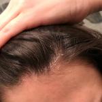 Сухость волосистой части головы у лба фото 2