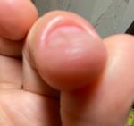 Темно-коричневая продольная полоска на ногте указательного пальца правой руки фото 5