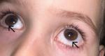 Покраснение глаз и беловаятая пленочка попадает на склерут фото 1