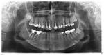 Резорбция зуба фото 1