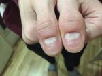 Деформация ногтей на больших пальцах фото 1