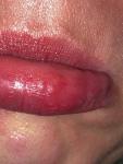 Бугорок на слизистой губы фото 1