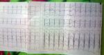 Учащенное сердцебиение, расшифровка ЭКГ фото 1