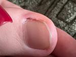 Потемнение на коже ногтя большого пальца ноги фото 1