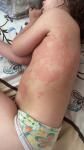 Аллергическая крапивница у ребёнка (неизвестно) фото 1