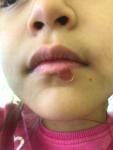 Шелушение на голове у девочки, болячка возле губы фото 2