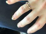 Трещины на пальцах и кожный зуд фото 2