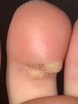 Болячка на пальце ноги фото 2