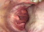 Тонзиллит и боль в ухе фото 1