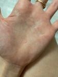 Мелкие прыщики на руках, шелушение и трещины на пальцах фото 4