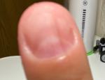 Темно-коричневая продольная полоска на ногте указательного пальца правой руки фото 4