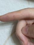 Зуд пальце руки и уплотнения кожи фото 1