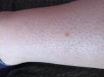 Красное пятно на ноге выпуклое над кожей фото 1