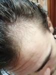 Возможно ли восстановить волосы после кратковременного выпадения? фото 4