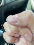 Повреждение ногтя после аппаратного маникюра фото 3