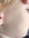 У ребенка на щеке белое пятнышко! фото 3