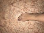 Травма большого пальца на правой ноге фото 2