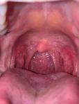 Сыпь в горле при коронавирусе фото 2