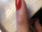 Красное пятно на пальце руки фото 1