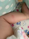 Сыпь у ребёнка 6 месяцев фото 1