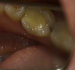 Ноющие боли зуба фото 1