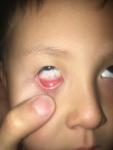 Красный глаз у ребенка фото 2