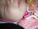 Акне новорожденных или аллергия фото 4