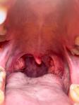 Ком в горле воспаление миндалин фото 2