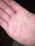 Атопический дерматит, грибок кожи рук и ногтей, что это? фото 3