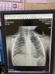 Пневмония или нет в сегменте s8 правое лёгкое фото 1