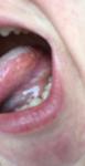 Воспаление языка по бокам фото 2
