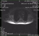 Неосложненный компрессионный перелом тела L1 позвонка 1 степени у ребенка фото 3