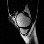Гиперчуствительность сухожилия ниже колена снаружи фото 3