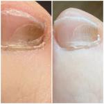 Подногтевая гематома на пальце ноги фото 1