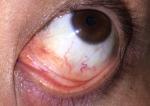 Красные капилляры глаз под нижнем веком фото 2