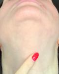 Заеда в уголке губ, воспаление лимфоузла фото 1