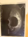 Кисты на яичнике, эндометриоз, беременность фото 2