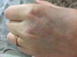 Сыпь на руке при беременности фото 1