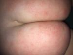 Аллергия или контактный дерматит у ребёнка фото 4