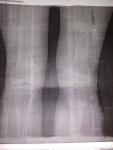 Артроз коленных суставов фото 1